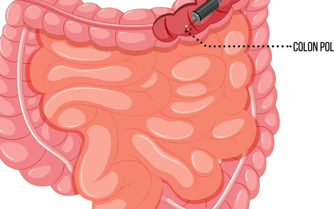 diagram of colon and colonoscopy device