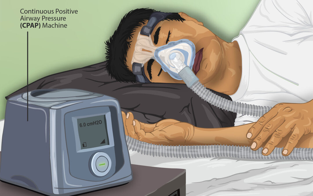 depiction of sleep apnea patient using CPAP machine